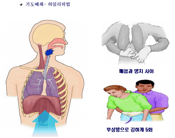 하임리히법